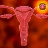 Ectopic pregnancy