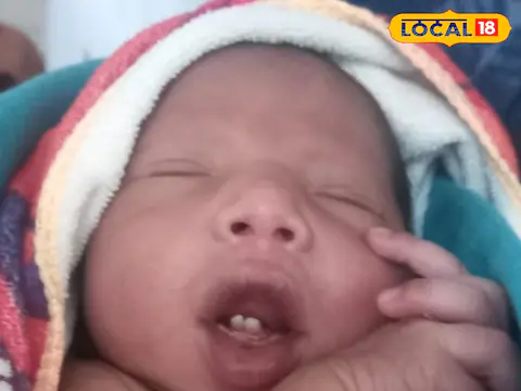 Infant Born With Two Teeth, Doctors Surgically Removed the Teeth