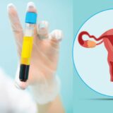 PRP therapy