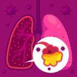 Granulomatosis with Polyangiitis