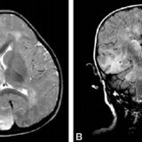 Subacute Sclerosing Panencephalitis