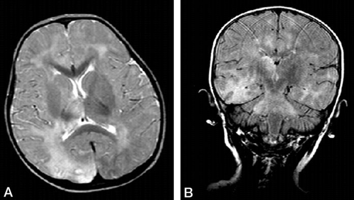 American journal of neuroradiology Subacute Sclerosing Panencephalitis