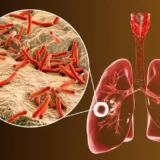 Drug-Resistant - Mother and Baby Matters