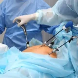 Endometriosis