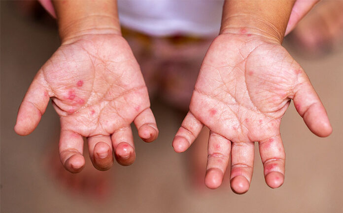 Hand Foot Mouth Disease (HFMD): How to Prevent and Treat HFMD