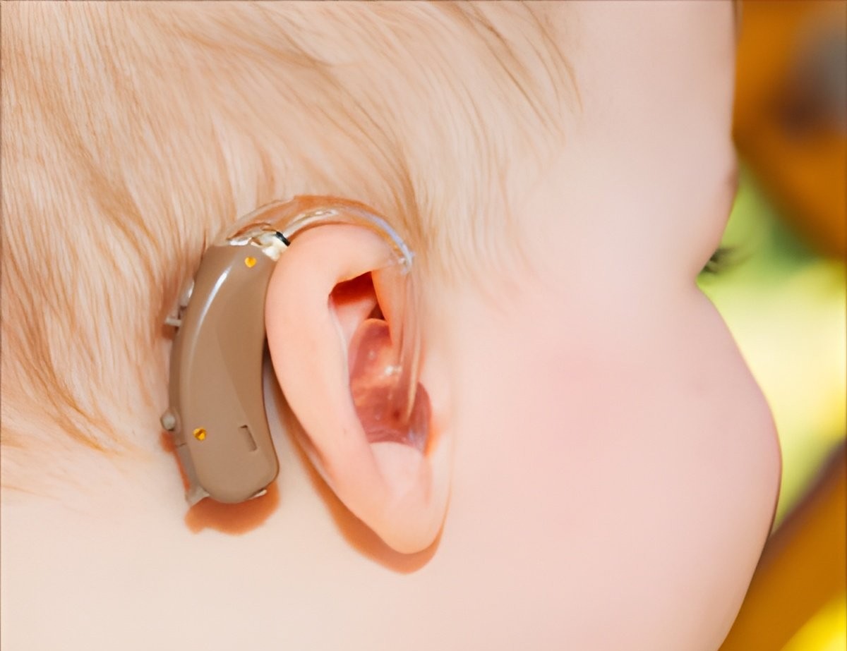 Cochlear Implant
