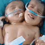 Conjoined Twins | Mother And Baby Matters