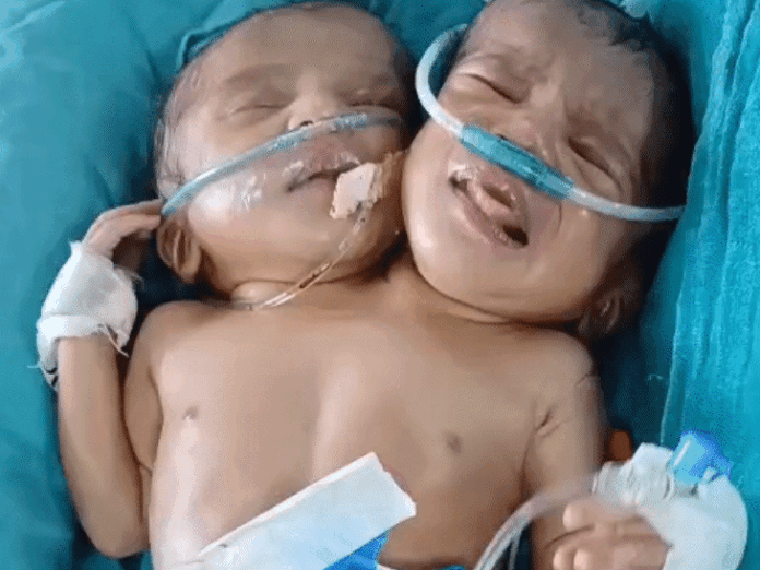 Conjoined Twins | Mother And Baby Matters Conjoined Twins | Mother And Baby Matters
